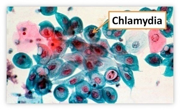 Vi khuẩn chlamydia là gì? Tác nhân nguy hiểm gây bệnh Chlamydia