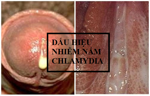 Dấu hiệu nhiễm nấm Chlamydia ở nam và nữ