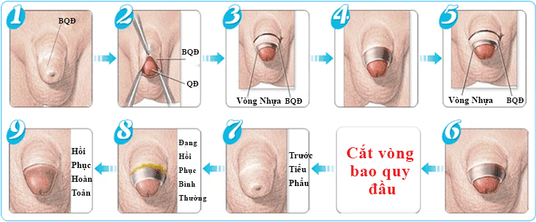 Quá trình tiến hành tiểu phẫu cắt hẹp bao quy đầu