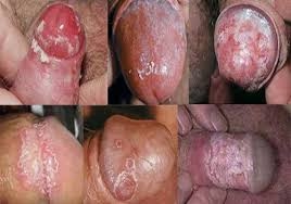Hình ảnh nhiễm nấm Candida ở cơ quan sinh dục nam