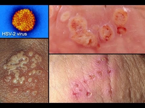 Virus HSV-2 gây bệnh mụn rộp sinh dục nguy hiểm ở người