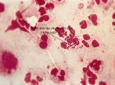 Hình ảnh song cầu lậu khuẩn qua kính hiển vi