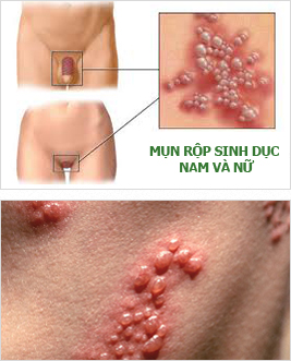 Kĩ thuật GPH - điều trị viêm nhiễm cơ quan sinh dục 1
