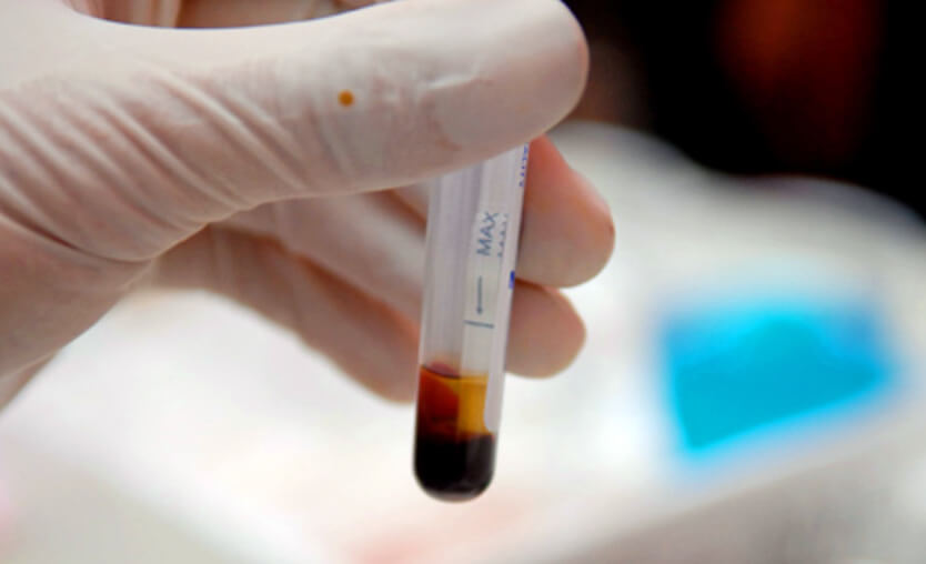 xét nghiệm máu giúp chẩn đoán chính xác bệnh lậu