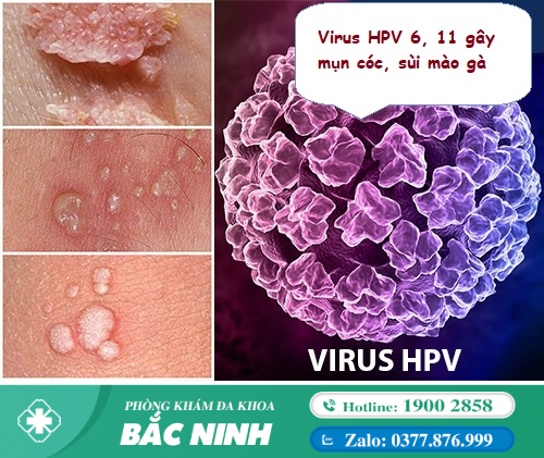 Virus HPV là gì? Những thông tin cần biết